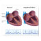 Heart disease atrial fibrillation Poster