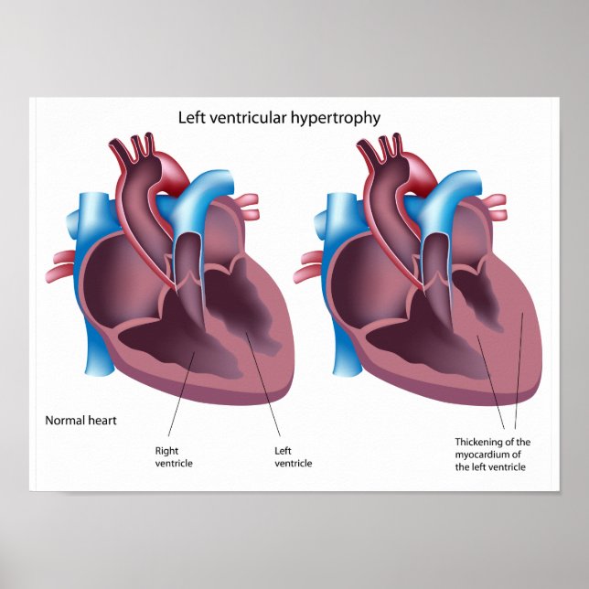 Heart hypertrophy Poster (Front)