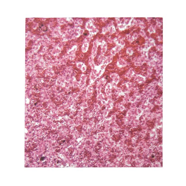 Human liver cells with cancer notepad (Front)