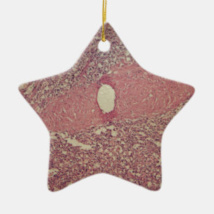 Human spleen with chronic myelogenous leukaemia ceramic tree decoration