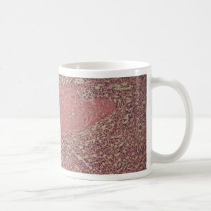 Human spleen with chronic myelogenous leukaemia coffee mug