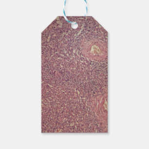 Human spleen with chronic myelogenous leukaemia gift tags