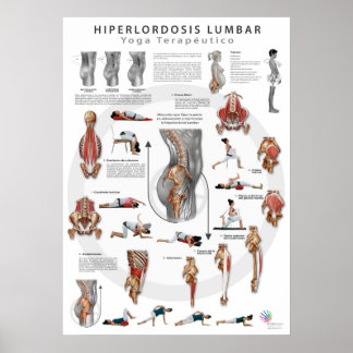 Hyperlordose - definition, causes and treatment poster