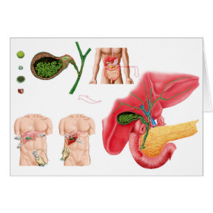 Illustration Depicting Cholecystectomy