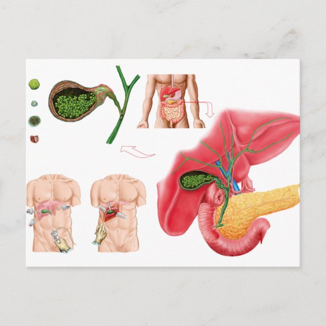 Illustration Depicting Cholecystectomy Postcard (Front)