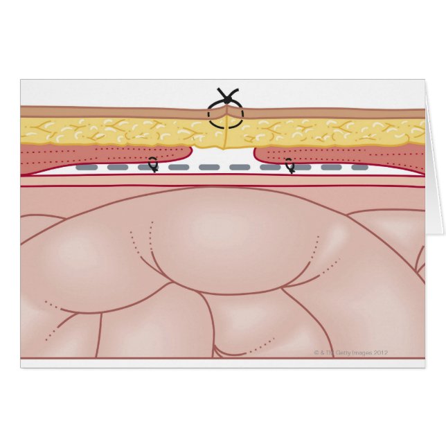 Illustration of a Hernia (Front Horizontal)