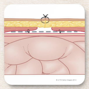Illustration of a Hernia Coaster
