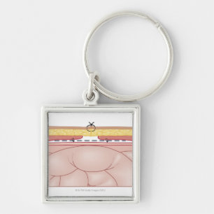 Illustration of a Hernia Key Ring