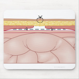 Illustration of a Hernia Mouse Mat