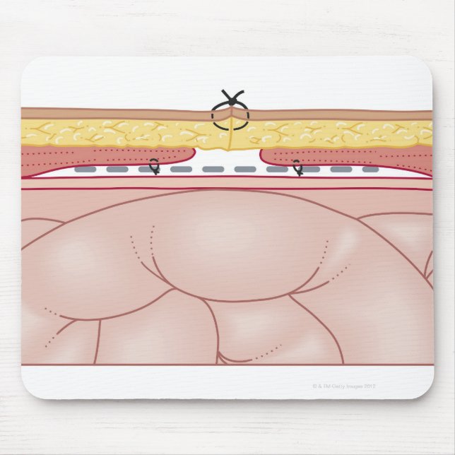 Illustration of a Hernia Mouse Mat (Front)
