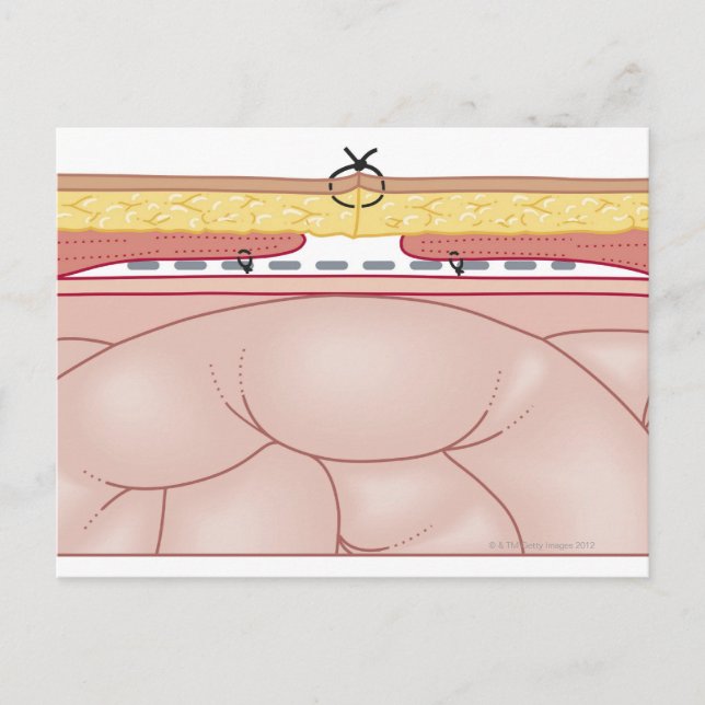 Illustration of a Hernia Postcard (Front)