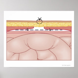 Illustration of a Hernia Poster
