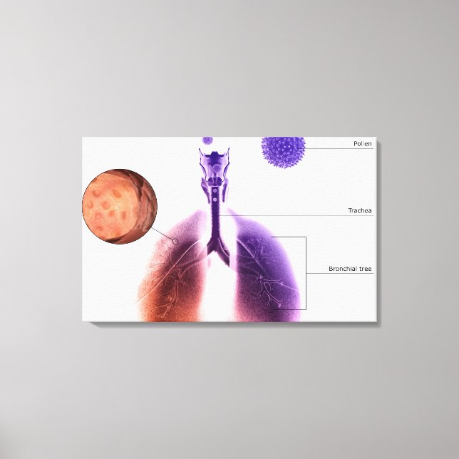 Illustration of an asthma attack from pollen canvas print (Front)