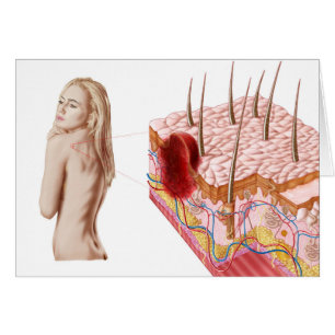 Illustration Of An Atypical Growth On The Skin