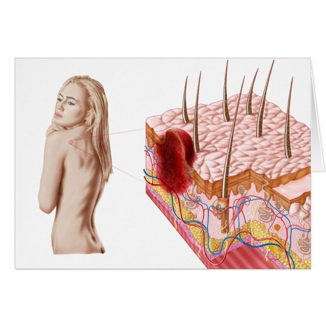 Illustration Of An Atypical Growth On The Skin (Front Horizontal)