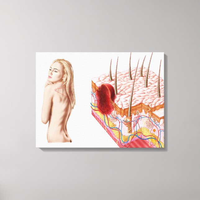 Illustration Of An Atypical Growth On The Skin Canvas Print (Front)