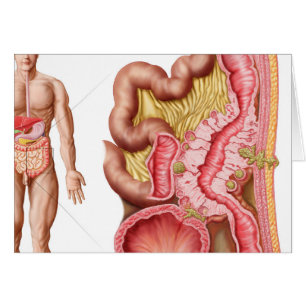 Illustration Of Diverticulosis In The Colon