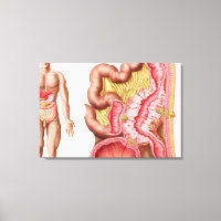 Illustration Of Diverticulosis In The Colon