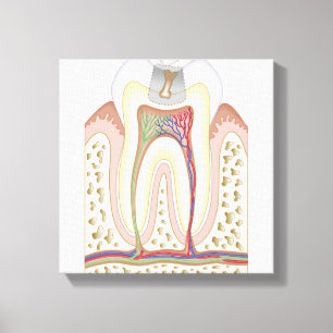 Illustration of Tooth Decay Canvas Print