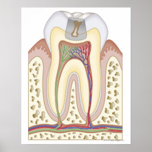 Illustration of Tooth Decay Poster