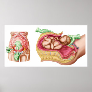 Illustration Showing Caesarean Delivery Of Foetus Poster