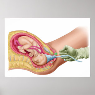 Illustration Showing Delivery Of Fetus 1 Poster