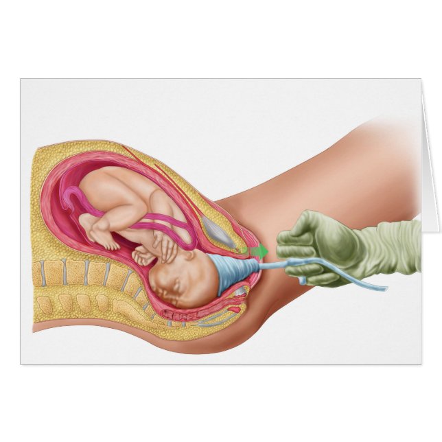 Illustration Showing Delivery Of Foetus 1 (Front Horizontal)