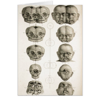 Infant Skull Deformities Weird/Conjoin Baby