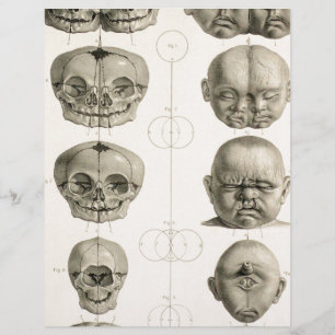 Infant Skull Deformities Weird/Conjoin Baby