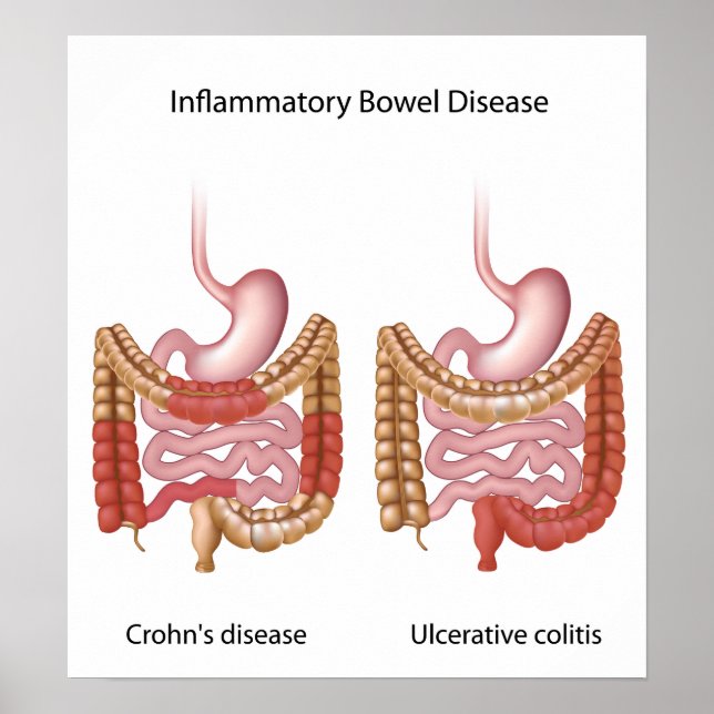 inflammatory bowel disease (ibd) poster (Front)