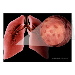 Inflammed airway during an asthma attack