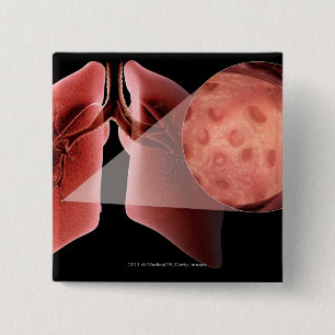 Inflammed airway during an asthma attack 15 cm square badge