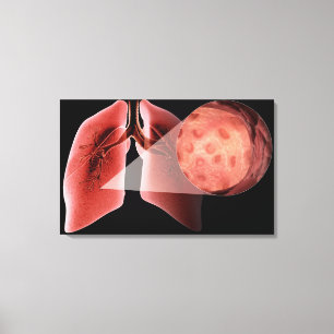 Inflammed airway during an asthma attack canvas print