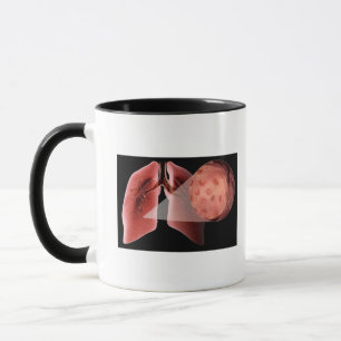 Inflammed airway during an asthma attack mug