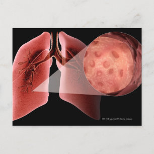 Inflammed airway during an asthma attack postcard