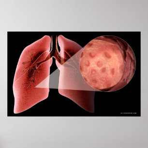 Inflammed airway during an asthma attack poster