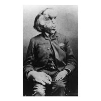 Joseph "John" Merrick The Elephant Man from 1889