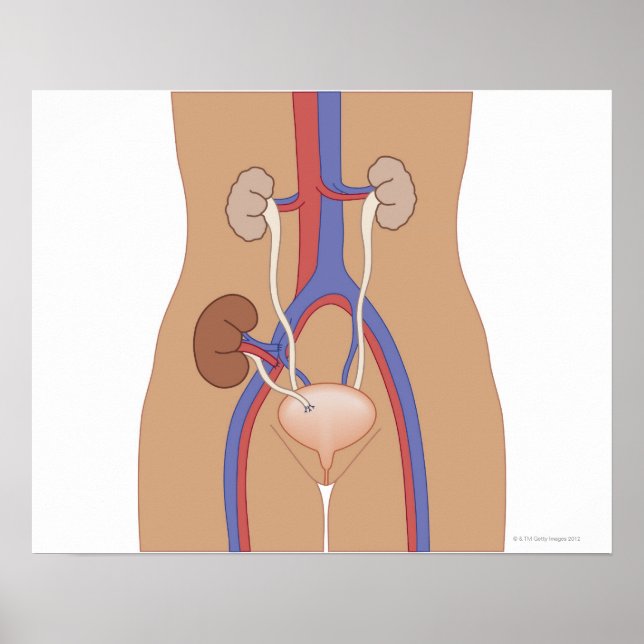 Kidney Transplant Poster (Front)