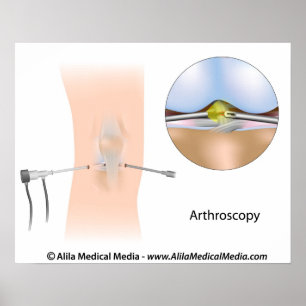 Knee arthroscopy diagram. poster