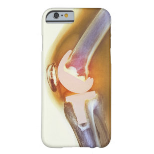 Knee replacement. Coloured X-ray of a total knee Barely There iPhone 6 Case