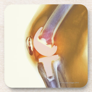 Knee replacement. Coloured X-ray of a total knee Coaster