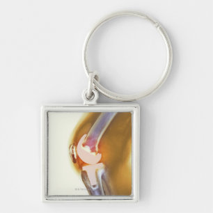 Knee replacement. Coloured X-ray of a total knee Key Ring