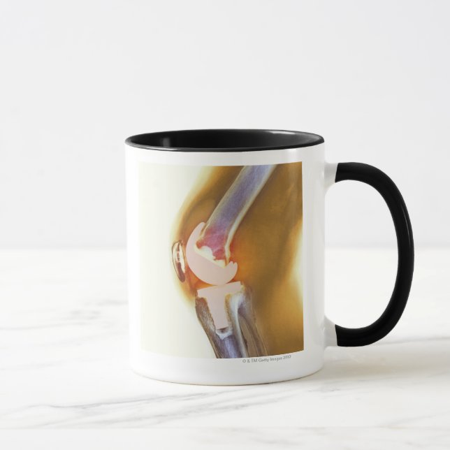 Knee replacement. Coloured X-ray of a total knee Mug (Right)