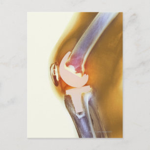 Knee replacement. Coloured X-ray of a total knee Postcard