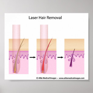 Laser hair removal procedure poster