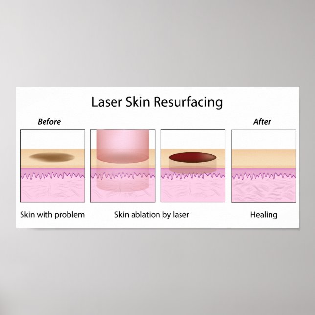 Laser skin resurfacing procedure poster (Front)