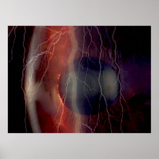 Lightning Over a Torn Cornea Poster (Front)