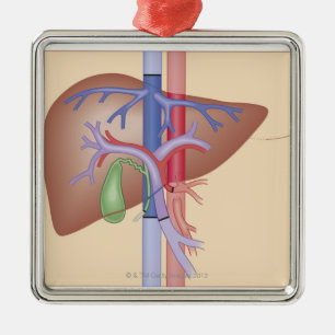 Liver Transplant Procedure Metal Tree Decoration