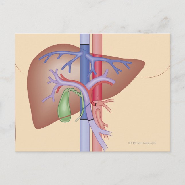 Liver Transplant Procedure Postcard (Front)