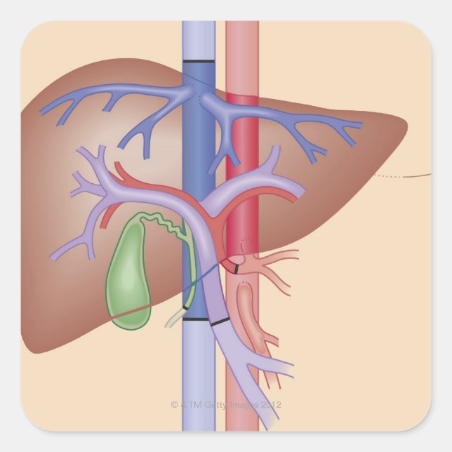 Liver Transplant Procedure Square Sticker (Front)